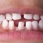 Spaced Teeth