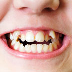 Crowded Teeth